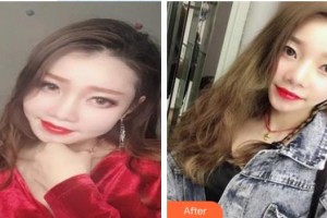 蘭溪市人民醫(yī)院整形燒傷外科廖和根整形價(jià)格表附超聲提拉案例展示