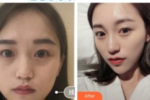 睢寧圣蓉醫(yī)療美容診所魏子整形價(jià)格表附埋線提升案例展示