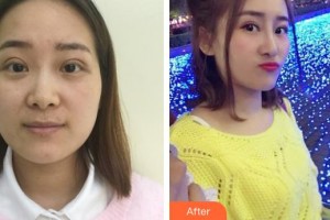 丹陽市人民醫(yī)院整形外科王延明整形價(jià)格表附激光美膚激光案例展示