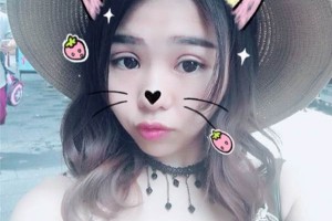 南京鼓樓燒傷科雙眼皮怎么樣附手術(shù)圖