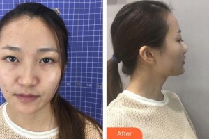 沭陽縣人民醫(yī)院皮膚整形美容科張守俊整形價格表附鼻部綜合案例展示