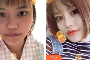 沭陽縣人民醫(yī)院皮膚整形美容科陶士陽整形價格表附鼻部綜合案例展示