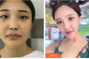 沭陽縣人民醫(yī)院皮膚整形美容科王湘臻住院醫(yī)師整形價格表附鼻部綜合案例展示