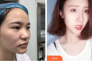 董軍整形價格表附鼻部綜合案例展示