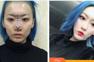 德宏富華醫(yī)學(xué)整形美容門診部李樹興整形價格表附假體隆鼻案例展示