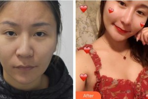 溧陽圣藍醫(yī)院整形美容中心相汝東整形價格表附鼻修復(fù)案例展示