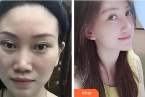 克拉瑪依市中心醫(yī)院燒傷整形科蔣永能整形價格表附隆鼻案例展示