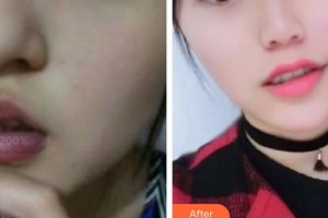 張掖星范整形美容醫(yī)院羅虹霞整形價格表附微針去頸紋案例展示