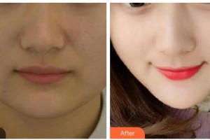 雙鴨山孫笠醫(yī)療美容診所孫力整形價格表附埋線提升案例展示