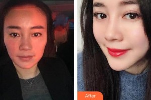 泰興柏麗整形美容醫(yī)院姚為群整形價格表附埋線提升案例展示