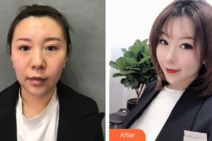 廣州塑妍醫(yī)療美容門診部陶毅整形價格表附埋線提升案例展示