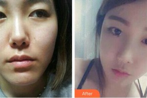 廣州壹加壹美容醫(yī)院黃其然整形價格表附埋線提升案例展示