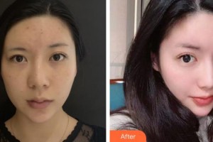 陽江市人民醫(yī)院燒傷整形外科黃春曉整形價格表附熱拉提案例展示