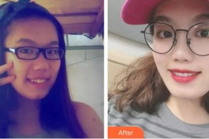 梅河口百顏醫(yī)療美容醫(yī)院宋榮整形價格表附隱形托槽矯正案例展示