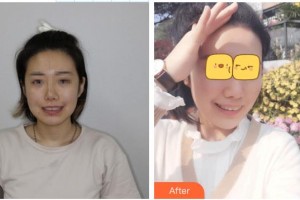 溧陽嘉豐醫(yī)療門診部董欽曉整形價格表附牙齒隱形矯正案例展示