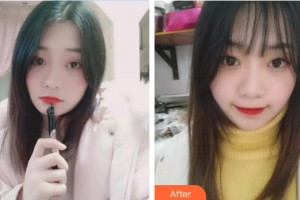 永年李婷醫(yī)院整形科李婷整形價格表附金屬托槽矯正案例展示