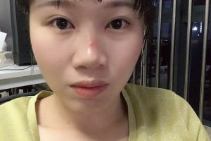 信陽(yáng)中心醫(yī)院雙眼皮怎么樣附價(jià)格表