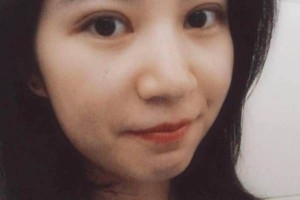 ?復(fù)旦大學(xué)附屬中山醫(yī)院怎么樣？附埋線雙眼皮果圖