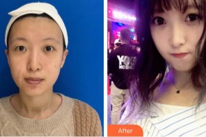 紅河白天鵝醫(yī)療美容門(mén)診部羅晶整形價(jià)格表附清潔祛痘案例展示