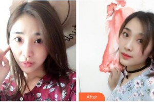 平?jīng)隹得泪t(yī)療美容門(mén)診部于曉萍整形價(jià)格表附光子嫩膚案例展示