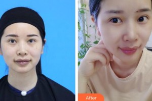 安岳潤(rùn)白顏醫(yī)療整形美容門(mén)診部于華平整形價(jià)格表附微針?biāo)獍咐故?>
</a>
<h3 class=