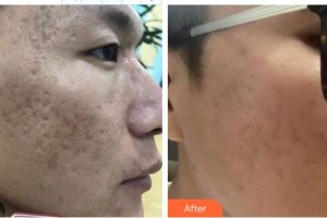 楚雄現(xiàn)代婦產(chǎn)醫(yī)院醫(yī)療美容科胡春梅整形價(jià)格表附去痘印痘坑案例展示