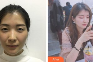 普洱云美婦產(chǎn)醫(yī)院醫(yī)療美容科文小燕整形價(jià)格表附微針?biāo)獍咐故?>
</a>
<h3 class=