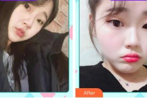 鞍鋼集團(tuán)總醫(yī)院醫(yī)療美容醫(yī)院馬曉文整形價(jià)格表附無(wú)針?biāo)獍咐故?>
</a>
<h3 class=