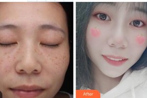 鞍鋼集團(tuán)總醫(yī)院醫(yī)療美容醫(yī)院程野整形價(jià)格表附激光祛斑案例展示