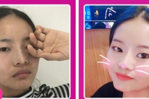 張掖華美醫(yī)療美容醫(yī)院彭書(shū)強(qiáng)整形價(jià)格表附去痘印痘坑案例展示