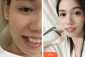 京良鄉(xiāng)優(yōu)貝口腔門(mén)診部姜茂慶整形價(jià)格表附金屬托槽矯正案例展示