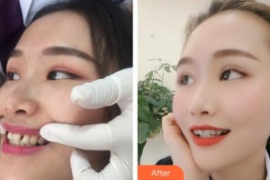 京良鄉(xiāng)優(yōu)貝口腔門(mén)診部蒲楊磊整形價(jià)格表附隱形托槽矯正案例展示