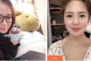 溧陽(yáng)幫明口腔門(mén)診部馬金盼整形價(jià)格表附金屬托槽矯正案例展示