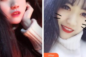 楚雄龐氏口腔門診部謝裕蓉整形價(jià)格表附牙貼面案例展示