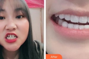 酒泉市口腔醫(yī)院王榮整形價(jià)格表附金屬托槽矯正案例展示