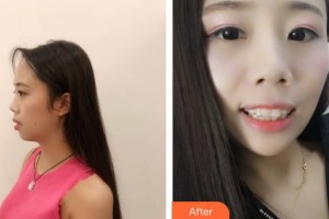 酒泉市口腔醫(yī)院常占兄整形價(jià)格表附牙齒隱形矯正案例展示