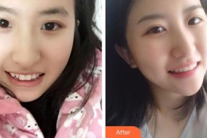 楚雄龐氏口腔門診部胡長(zhǎng)紅整形價(jià)格表附牙齒隱形矯正案例展示