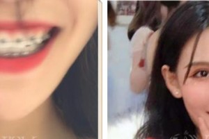 西藏阜康醫(yī)院口腔科劉瑞楠整形價(jià)格表附美白貼片案例展示