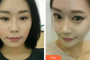 李寧生整形價(jià)格表附埋線提升案例展示