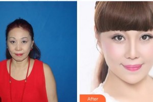 汪志強(qiáng)整形價(jià)格表附埋線提升案例展示