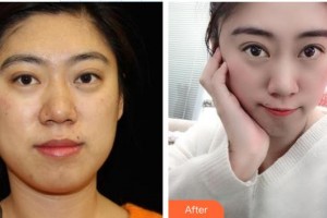 公安縣中西結(jié)合燒傷醫(yī)院燒傷整形美容科徐昌瑛整形價(jià)格表附熱瑪吉案例展示