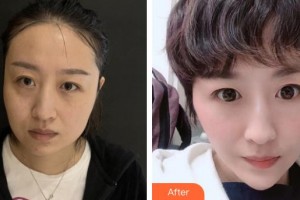 臨清市人民醫(yī)院手足顯微燒傷整形外科田培文整形價(jià)格表附熱瑪吉案例展示