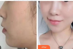 渭南凡爾賽明雅醫(yī)療美容診所曾祥文整形價(jià)格表附埋線提升案例展示