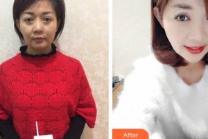 沾化縣人民醫(yī)院整形美容科王玉整形價(jià)格表附埋線提升案例展示