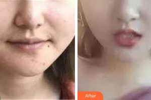 肥城市中醫(yī)院美容科王永紅整形價(jià)格表附埋線提升案例展示