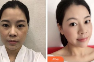 成武縣人民醫(yī)院醫(yī)學(xué)美容科張鳳云整形價(jià)格表附埋線提升案例展示
