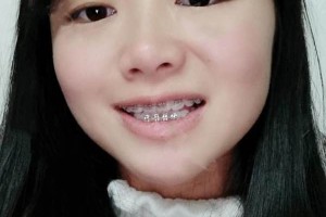 北京同仁醫(yī)院牙科怎么樣牙齒矯正果分享附果圖