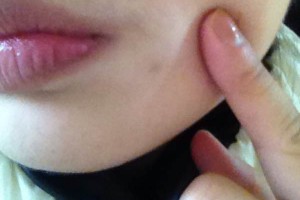 武漢協(xié)和醫(yī)院脫唇毛價(jià)格多少錢附價(jià)格表|醫(yī)生推薦