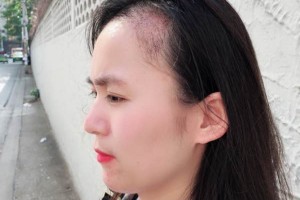 廣西醫(yī)科大一附院有稙發(fā)嗎？附發(fā)際線種植果圖