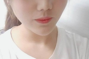 北醫(yī)三院雙眼皮李東怎么樣附價格表